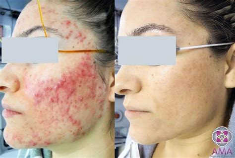 qs; st. . Cystic acne removal videos